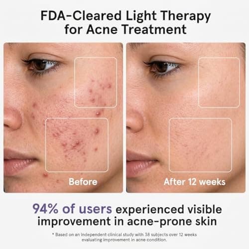 MICEYLIVE Red Light Therapy for Face Mask, Blue Light Therapy for Acne, Gifts for Women, Wrinkle LED Face Mask, 432 LED with Full Face Coverage & 3 Light Modes, Travel Bag for Home Use & Travel, pink - Thumbnail 2