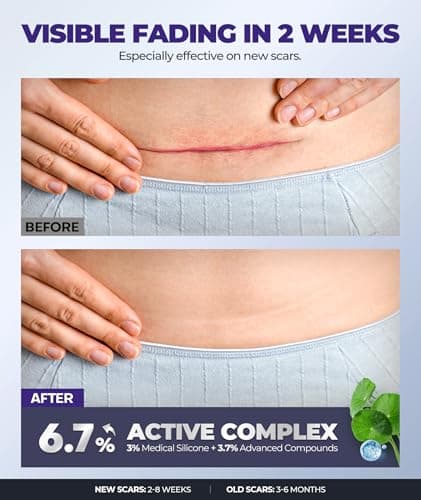 Silicone Scar Cream with 6.7% Active Ingredients, Scar Gel Visible in 2 Weeks, Moisturizing Scar Removal Clinically Show for Surgical, C-Section, Keloid, Acne & Burn Scars, Stretch Mark Cream(55ML) - Thumbnail 2