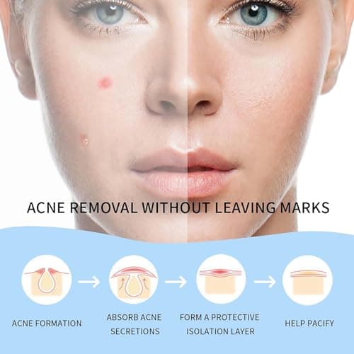 Safirst Zit Patch Hydrocolloid Acne Patches 2 Sizes Invisible Spot Blemish Stickers Easy Removal Treatment for Breakouts Absorbs Zits Hiding Face Emergency Treatments - Thumbnail 3