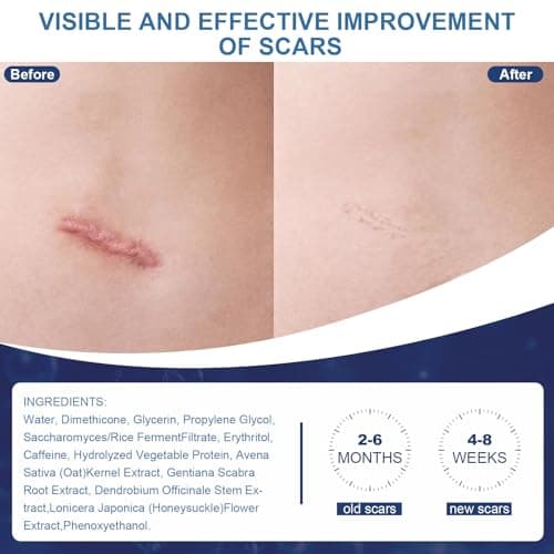 ARTLIB Scar Cream,Silicone Scar Gel,Helps Reduce Surgical Scars,Acne,Burn,Keloids Bump,Stretch Marks, Advanced Scar Removal Cream for Old and New Scars(1.69oz) - Thumbnail 5