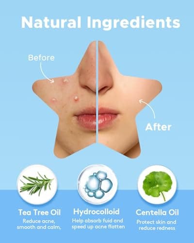 LitBear Acne Patch Pimple Patch, 6 Colors 240 Dots Star Pimple Patches with Tea Tree Oil & Centella Oil, Hydrocolloid Acne Pimple Patches for Face Cute Zit Patches Pimple Stickers Acne Dots - Thumbnail 3