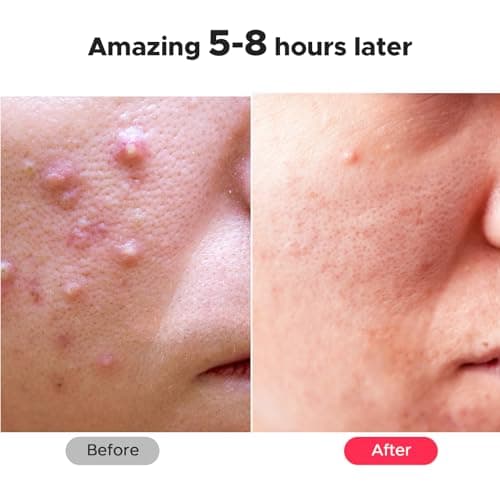 LitBear Large Pimple Patches, 5 Sizes 324 Patches Big Acne Patches, XL Hydrocolloid Bandages for Full Face, Forehead, Chin, Nose, Body, Back, Neck & Chest, Stirp, Square Large hydrocolloid Patch - Thumbnail 6