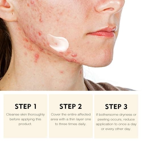 YAFUSIPE Acne Treatment for Face for Hormonal Cystic Stubborn Acne Cream for Sensitive Skin Teens Adults Women Men Spot Pimple Butt Control Rapid Clearing Breakout Overnight Face Blemish Treatment - Thumbnail 4