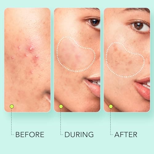 LitBear Large Pimple Patches (7 Sizes 306 Patches), Big Acne Patches, XL Hydrocolloid Bandages for Full Face, Forehead, Chin, Nose, Body, Back, Neck & Chest, Oval, Moon, Square hydrocolloid Patch - Thumbnail 5