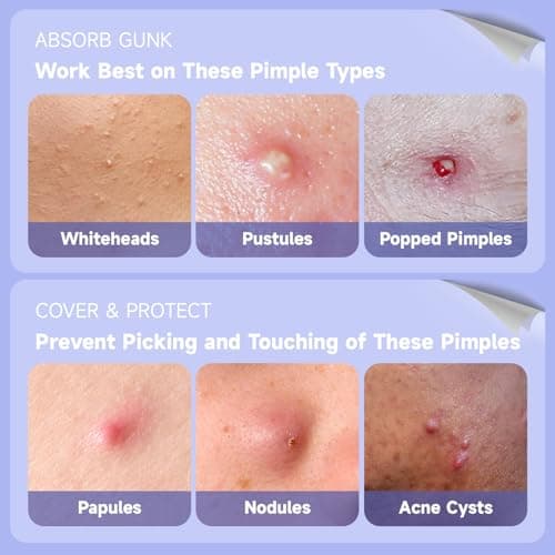 Dazzlook Ultra Pimple Patch Variety Pack Hydrocolloid Pimple Patches with Salicylic Acid for Covering Small & Large Zits and Blemishes, Spot Stickers for Face and Skin (36 Counts) - Thumbnail 3
