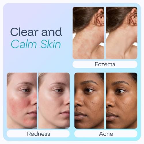 SAFOLYTE Hypochlorous Acid Spray for Face & Skin – HOCl Face Mist for Redness, Irritated, Acne & Sensitive Skin | Dermatologist Tested, Alcohol-Free, Fragrance-Free | Daily Soothing Toner, 8oz - Thumbnail 2