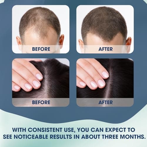 Hair Growth Serum Roll On, Suitable for All Hair Types Prevents Hair Loss Nourishes Hair Follicles Achieve Thicker Hair for Men & Women - Thumbnail 3