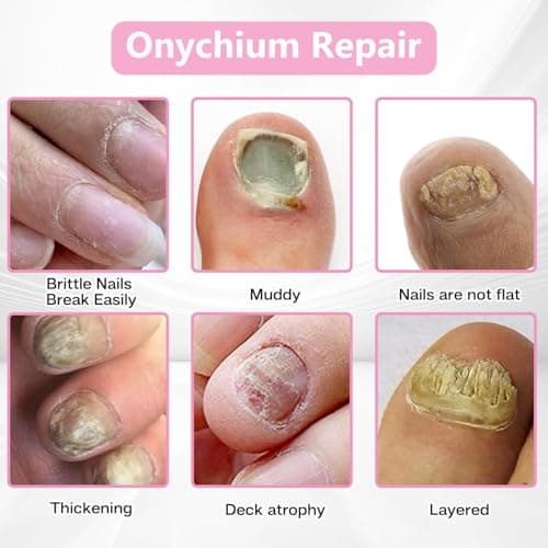 Fungal Nail Patches 60 Pcs – Extra Strength Hydrogel Treatment for Toenail Fungus, Upgraded Overnight Repair Nail Patches, 8-Hour Nighttime Nail Fungus Patches for Nail Fungus Treatment - Thumbnail 6