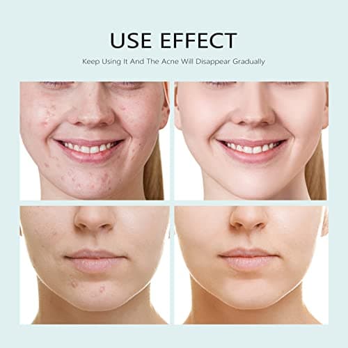 YAFUSIPE Facial Mask Anti Acne Face Masks Skin Care, Sheet Masks With Salicylic Acid Sheet For Acne Prone Hydrating Moisturizing Skincare for Scar Breakouts Pimple Beauty Oil Control Redness 10 Sheets - Thumbnail 2