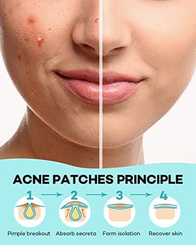 TKTK Pimple Patch Acne Patch, 4 Sizes 140 Patches Acne Absorbing Cover Patch, Hydrocolloid Invisible Acne Patches for Face Zit Patch Acne Dots Tea Tree, Calendula Oil - Thumbnail 6