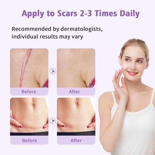 Medical Grade Silicone Scar Gel - Advanced Scar Removal Cream & Scar Treatment for Surgical, C-Section, Hypertrophic & Acne Scars - 1.7oz - Thumbnail 5