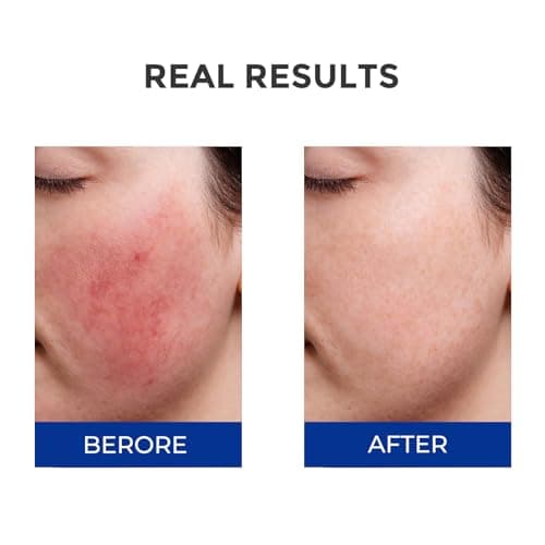 SKINERSE Moisturizing Barrier Serum, 4D Hyaluronic Acid Serum for Face with Vitamin B5 and Ceramides, Anti-Aging Hydrating, Plump and Repair Dry Skin, Daily Skin Care Treatment 1oz - Thumbnail 4