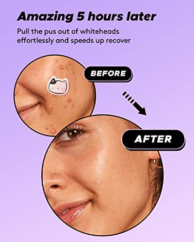LitBear Acne Patch Pimple Patch, Cat Shaped Acne Absorbing Cover Patch, Hydrocolloid Acne Patches For Face Zit Patch Acne Dots, Tea Tree Oil & Salicylic Acid, 96 Patches, 12mm - Thumbnail 6