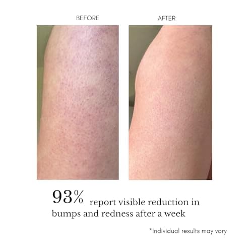 KP Bump Eraser – Advanced Triple-Acid Complex with 5% Glycolic Acid, AHA/BHA/PHA for Rough & Bumpy Skin, Helps Reduce Strawberry Legs, Razor Bumps, Ingrown Hairs & Body Breakouts, 120 ml - Thumbnail 3