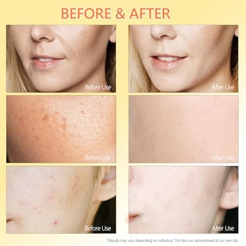 Pure 4% Niacinamide Serum for Acne Treatment for Face & Dark Spots | Brightening Face Serum with 1.5% Vitamin C | 1% Hyaluronic Acid | 1% Ceramide T5 | Made in China (4 fl.oz/120ml) Travel Pack Size - Thumbnail 6