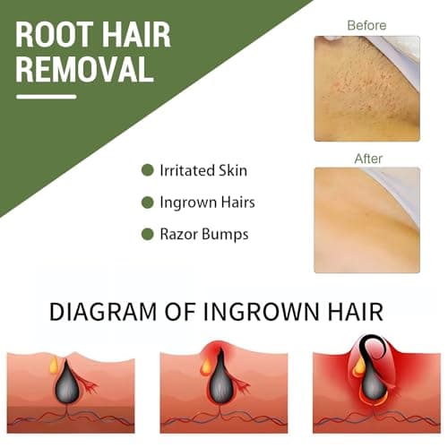Ingrown Hair Treatment, Ingrown Hair Patch,Razor Bump Treatment for Bikini Area,30 Patches,Quickly and Effectively Clear Up Ingrown Hair Bumps Patch Smooth-Feeling,Non-Irritating Formula,Unisex - Thumbnail 2