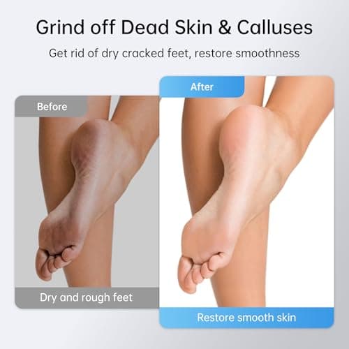 Electric Foot Callus Remover Rechargeable, 6 Speeds Adjustable USB Charging Foot Sander, Portable Electric Foot File Professional Foot Grinder for Dead Skin & Cracked Heel - Thumbnail 4