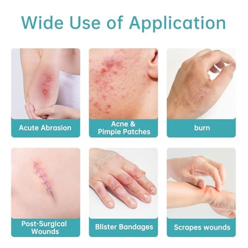 Medical Grade Hydrocolloid Bandages Roll, Hydrocolloid Pimple Patch Roll for Acne, Wound Care, Burns, Blisters, Bed Sore, First Aid Kit Essential, 0.3mm Thickness bandaids, 2in*16ft, Semi-Transparent - Thumbnail 5