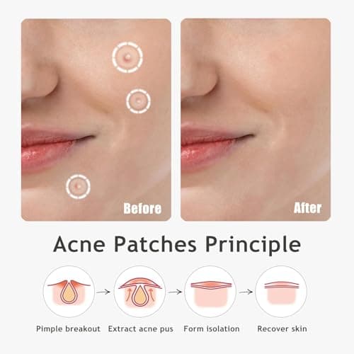 Dazzlook Ultra Pimple Patches, Zits and Blemishes Patch with Salicylic Acid (96 Counts), Invisible Hydrocolloid Pimple Stickers Large Bulk for Face and Skin - Thumbnail 6