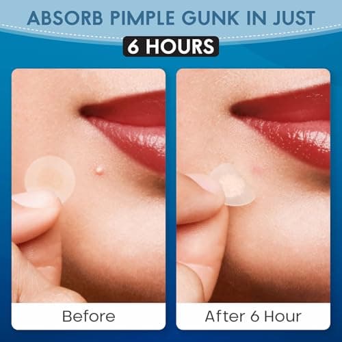 Zovira Invisible Pimple Patches (36 Count) – Ultra Thin Hydrocolloid Acne Patch for Daytime, Tapered Edges, Helps Reduce Redness in 15 Min, For Sensitive Skin - Thumbnail 6