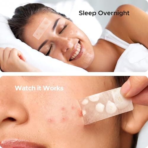 TKTK Large Pimple Patches for Face, 7 Sizes XL Acne Patches, Big Hydrocolloid Bandages for Body, Chin, Forehead, Chest, Back Zit Breakouts, Hydrocolloid Patch (Strip, Square, Dot 302 Count) - Thumbnail 4