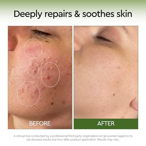 10% Azelaic Acid Serum Redness Soothing Face Serum with Niacinamide & Centella Asiatica Hydrating Acne Treatment for Sensitive Skin Azelaic Acid Formula Centella Asiatica CICA Facial Serum Skin Care - Thumbnail 4