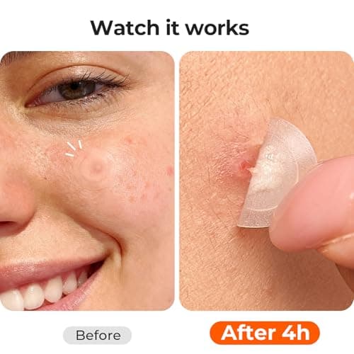 TKTK Pimple Patches for Face, 0.01cm Ultra-Thin Invisible Acne Patches, Hydrocolloid Patches for Breakouts, Absorbs Zits & Blemish, Suitable Under Makeup, 2 Sizes(10mm/12mm) 264 count - Thumbnail 4