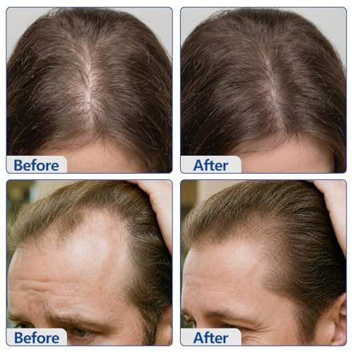 5% Minoxidil Hair Growth Cream for Men & Women - Biotin & Caffeine Scalp Cream Hair Regrowth Treatment for Thinning & Hair Loss, Non-Greasy, 3.5oz - Thumbnail 6