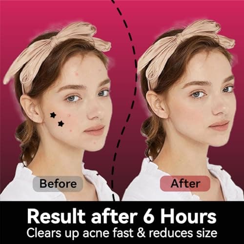 OMADOTO Star Pimple Patches for Face - Black Colors 66Pcs (14mm) Hydrocolloid Acne Patches, Day & Night Blemish/Zit Healing Pimple Patches(66count-Pack of 1) - Thumbnail 4