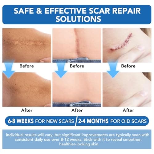 Clear Silicone Scar Sheets, Silicone Scar Tape(1.6"x 60" Roll-1.5M) - Reusable, Soft & Medical Grade Adhesive Tape for Old & New Scars, C-Section, Surgery, Keloid & Acne Scars - Thumbnail 6