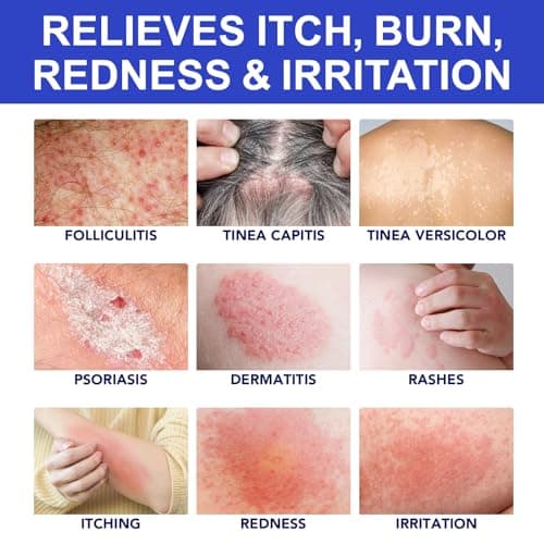 Acne Treatment for Face, Folliculitis Cream with 1% Salicylic Acid for Cystic – Multi-Purpose Gentle Herbal Formula for Scalp, Face & Body – Soothes Redness, Helps Prevent New Pimples, Fast Acting - Thumbnail 5