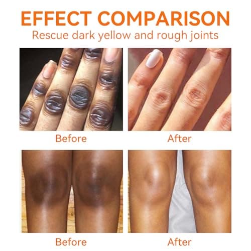 YAFUSIPE Dark Knuckle Remover Underarm Cream Body Moisturizer Lotion Dark Toe Knuckle Treatment Removal Corrector for Armpit Knees Elbow Inner Thigh Neck Private Part Intimate Skin Cream 4.21floz/120g - Thumbnail 2