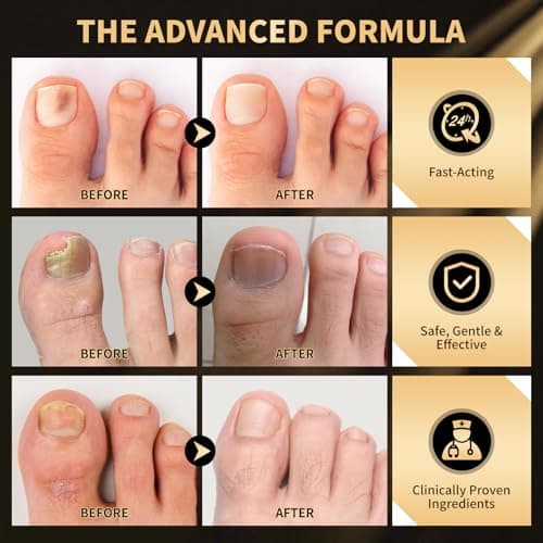 Toenail Fungus Treatment Extra Strength Pen for Damaged Toenail & Finger, More Pure Natural Plant Extracts, Toe Nail Fungus Renewal Patches & Toe Spacers for Damaged Nail for Women and Men - Thumbnail 6