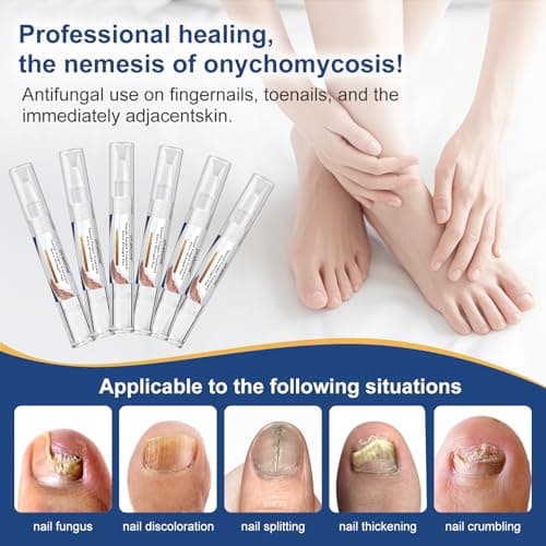 Toenail Fungi Treatment Extra Strength - Fungi Nail Pen, 25% Undecylenic Acid, Ingrown toenail treatment, Fungus nail treatment, yellow toenail, Damaged Nails foot fungus treatment extra strength - Thumbnail 2