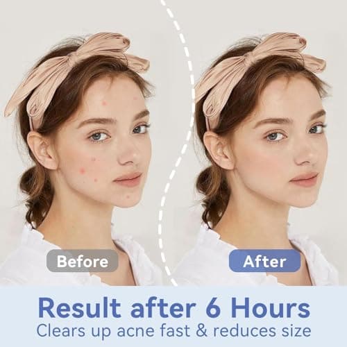 OmaDoto Invisible Pimple Patches for Face - （12mm | 72 Count | 6 Sheets） - Ultra-Thin Hydrocolloid Blemish Cover, Discreet Zit Stickers for Day & Night, Face Patches for Teens and Adults - Thumbnail 5