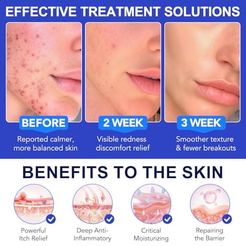 Acne Treatment for Face, Folliculitis Cream with 1% Salicylic Acid for Cystic – Multi-Purpose Gentle Herbal Formula for Scalp, Face & Body – Soothes Redness, Helps Prevent New Pimples, Fast Acting - Thumbnail 2