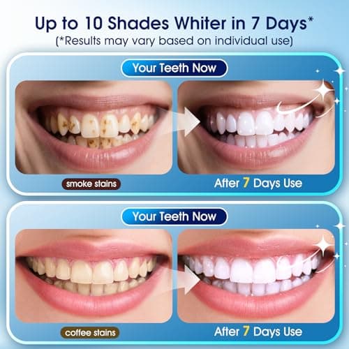 Teeth Whitening Kit – 3 Teeth Whitening Pens + 2 Desensitizing Pens – LED Light – 35% Carbamide Peroxide – Safe & Dentist-Recommended – Fast 7-Day Visible Whitening + Remineralizing Care - Thumbnail 2