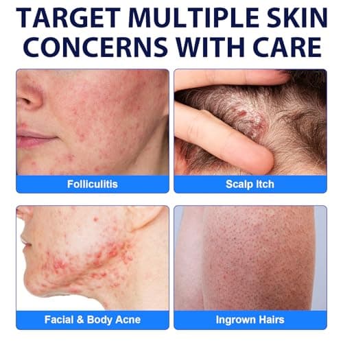 Acne Treatment for Face, Folliculitis Cream with 1% Salicylic Acid for Cystic – Multi-Purpose Gentle Herbal Formula for Scalp, Face & Body – Soothes Redness, Helps Prevent New Pimples, Fast Acting - Thumbnail 6