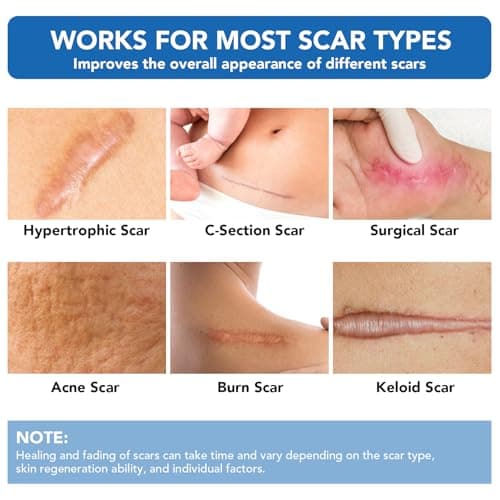 Clear Silicone Scar Sheets, Silicone Scar Tape(1.6"x 60" Roll-1.5M) - Reusable, Soft & Medical Grade Adhesive Tape for Old & New Scars, C-Section, Surgery, Keloid & Acne Scars - Thumbnail 2