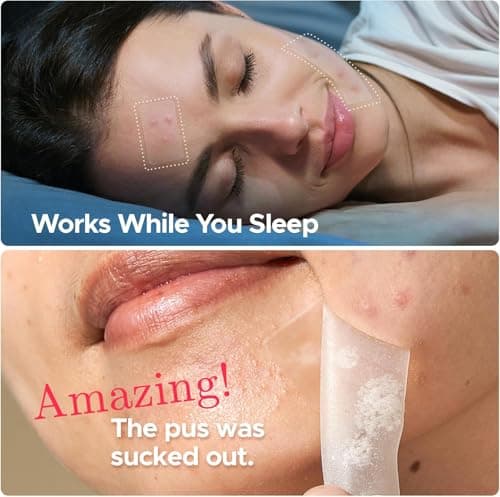 LitBear Large Pimple Patches, 5 Sizes 324 Patches Big Acne Patches, XL Hydrocolloid Bandages for Full Face, Forehead, Chin, Nose, Body, Back, Neck & Chest, Stirp, Square Large hydrocolloid Patch - Thumbnail 5