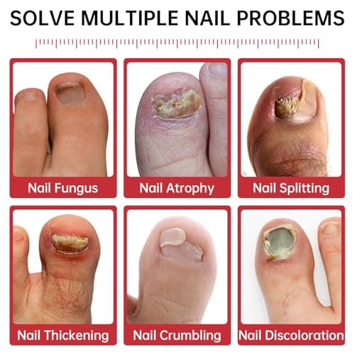 Nail Fungus Treatment Extra Strength – 1% Tolnaftate, Effective Treatment Under and Around Nails, Repairs Damaged Nails, Plant-Based Gentle Formula for Thickened and Discolored Nails, 0.51 fl.oz - Thumbnail 2
