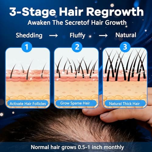 5% Topical Minoxidil Foam, Aerosol Minoxidil for Men, Infused with Biotin, Hair Growth Treatment, Supports Thicker and Fuller Hair & Beard Unscented (Minoxidil Foam, 8.44oz, 4 Months Supply) - Thumbnail 5