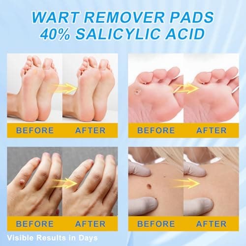 ZGjoib WART Corn Remover Pads for Feet 40% Salicylic Acid Wart Remover Pads, Corn Removers for Toes,Body - Thumbnail 2