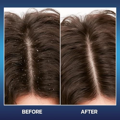 Jorceray Anti Dandruff Shampoo for Men with 3% Salicylic Acid – Deep Clean & Soothing Scalp Refresh for Oily & Itchy Scalp, Sulfate Free with Tea Tree & Menthol, 10.14 fl oz - Thumbnail 3