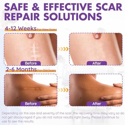 Silicone Scar Sheets, Silicone Scar Tape(1.6"x 118" Roll-3M), Reusable Professional Scar Silicone Strips, Soft Silicone Scar Sheets for Surgical Scars,Keloid,Acne Scars,Burn Scar,C-Section - Thumbnail 5
