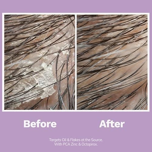 DORPANG Dandruff Shampoo for Oily Hair, Anti Dandruff and Oil Control Treatment Refresh Shampoo, Sulfate Free Daily Scalp Care, 355ml (12 fl oz) Floral Scent - Thumbnail 6