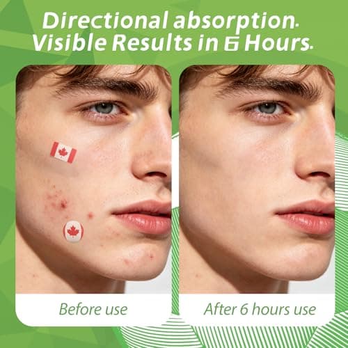 Anchiray Canada Flag & Soccer Design Hydrocolloid Pimple Patches for Face - with Tea Tree Oil, Salicylic Acid & Calendula Extract, for Team Canada Soccer Fans, Available day and night, 80 Counts - Thumbnail 5