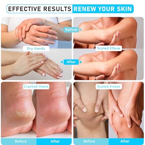 Urea 40% Foot Cream Maximum Strength - with Vitamin E & 2% Salicylic Acid - Deep Moisturizing for Winter Cracked Heels - Softens & Long Moisture for Rough Dead Skin on Hands, Feet, Elbows - Rich - Thumbnail 5