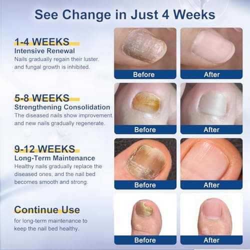 Toenail Fungi Treatment Extra Strength - Fungi Nail Pen, 25% Undecylenic Acid, Ingrown toenail treatment, Fungus nail treatment, yellow toenail, Damaged Nails foot fungus treatment extra strength - Thumbnail 4