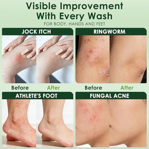 Oiangna Antifungal Soap, Tea Tree Antifungal Soap Bar for Back Acne, Athlete's Foot, Tinea, Ringworm, Jock Itch, Face & Body Wash Soothing Care for Men And Women, Relief of Itch - Thumbnail 6